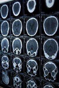 Brain Injuries