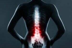Back Injury Lawyer Gainesville, GA